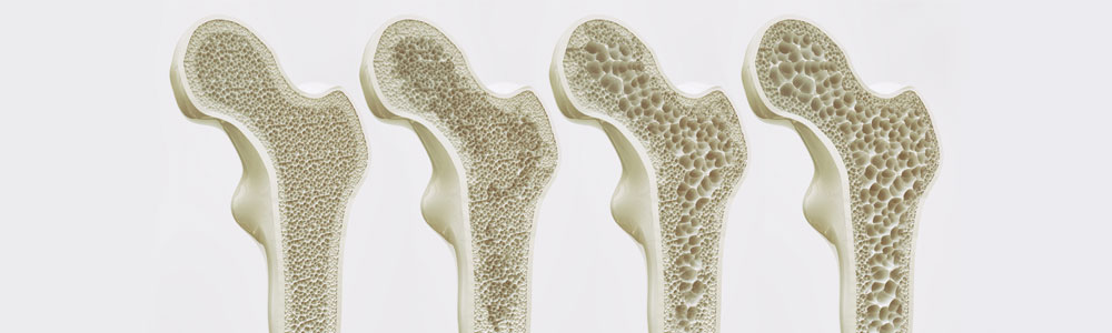 Read more about the article Osteoporosis