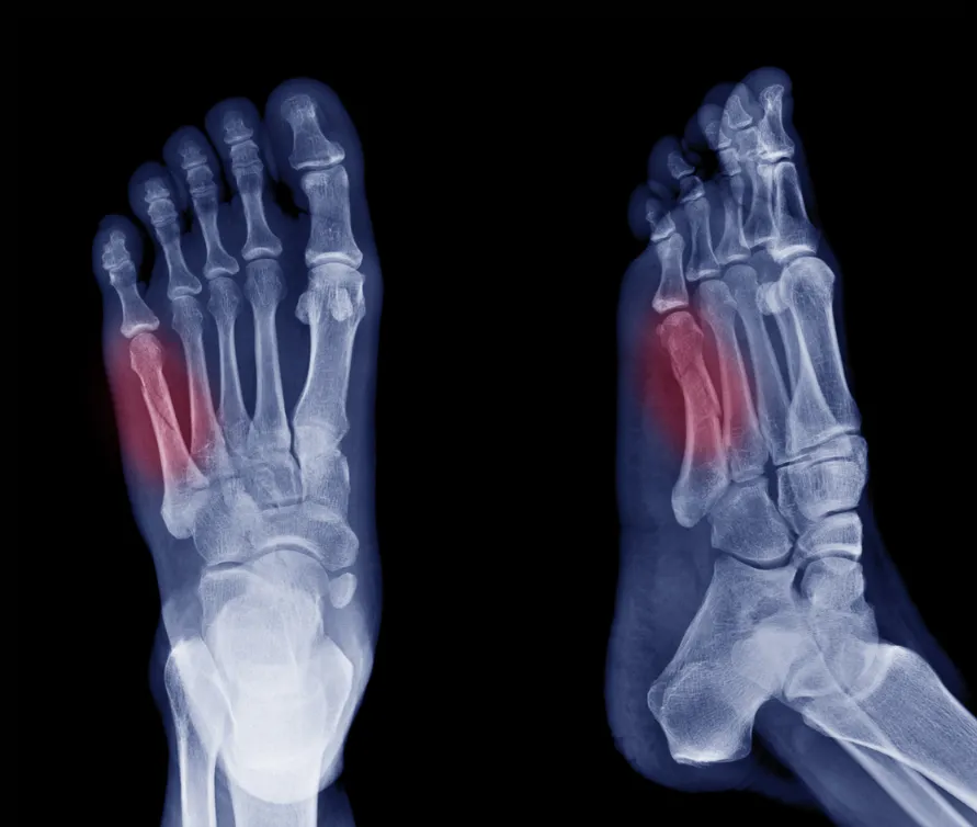 Read more about the article Broken Toes