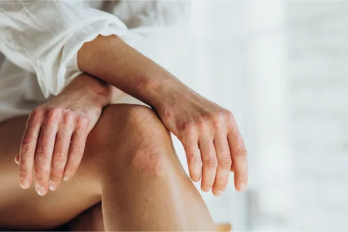 Read more about the article Understanding the Stress and Psoriasis Connection: How to Manage Both