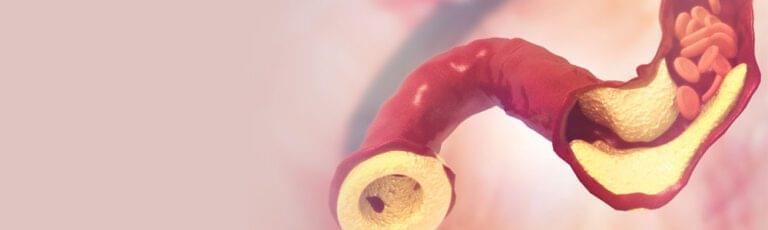 Read more about the article Cholesterol