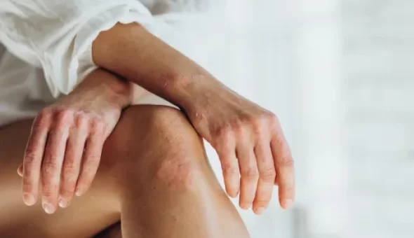 Understanding the Stress and Psoriasis Connection: How to Manage Both